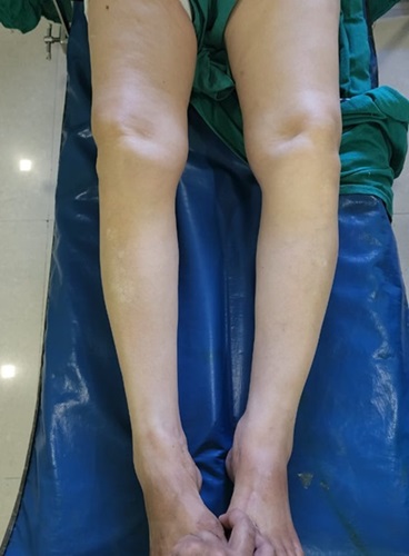 Robotic total Knee Replacement in Mandi HP